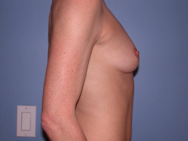 Breast Augmentation Gallery Before & After Gallery - Patient 4757544 - Image 3
