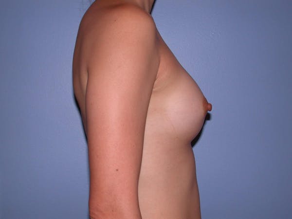 Breast Augmentation Before & After Gallery - Patient 4757553 - Image 4