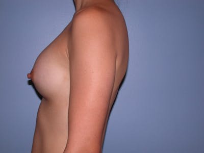 Breast Augmentation Gallery Before & After Gallery - Patient 4757553 - Image 6
