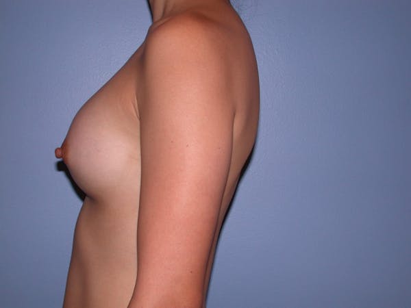 Breast Augmentation Gallery Before & After Gallery - Patient 4757553 - Image 6