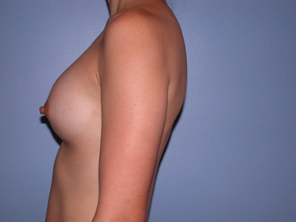 Breast Augmentation Before & After Gallery - Patient 4757553 - Image 6