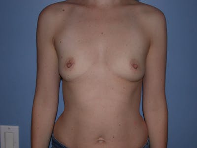 Breast Augmentation Gallery Before & After Gallery - Patient 4757562 - Image 1