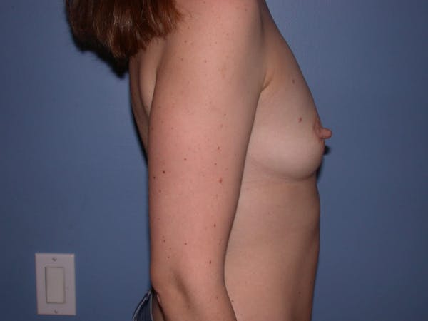 Breast Augmentation Gallery Before & After Gallery - Patient 4757562 - Image 3