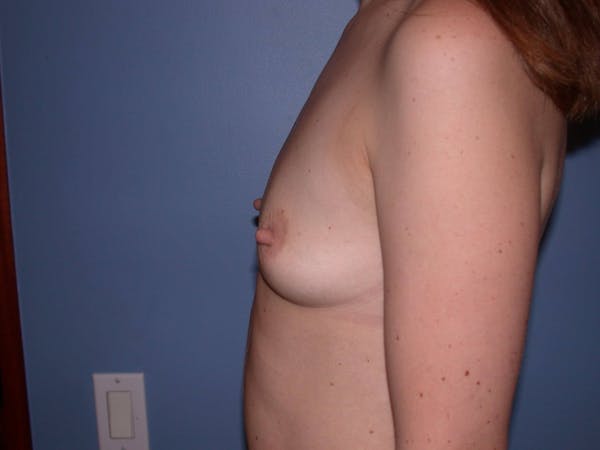 Breast Augmentation Gallery Before & After Gallery - Patient 4757562 - Image 5