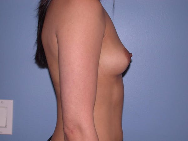 Breast Augmentation Gallery Before & After Gallery - Patient 4757564 - Image 3