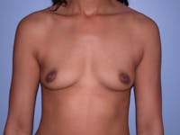 Breast Augmentation Gallery Before & After Gallery - Patient 4757569 - Image 1