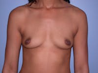 Breast Augmentation Before & After Gallery - Patient 4757569 - Image 1