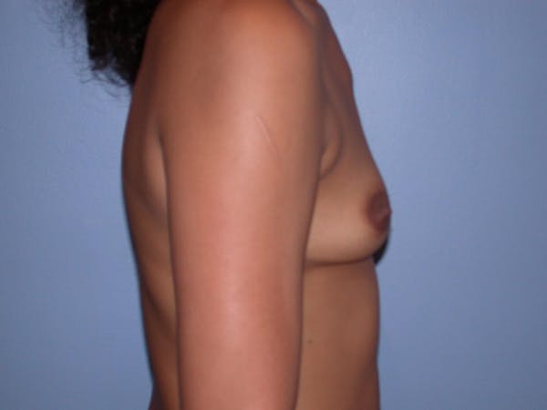 Breast Augmentation Gallery Before & After Gallery - Patient 4757569 - Image 3