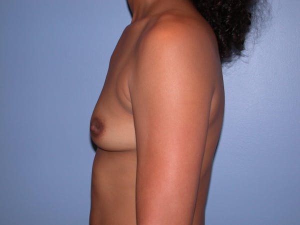 Breast Augmentation Gallery Before & After Gallery - Patient 4757569 - Image 5
