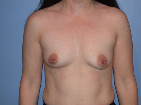 Breast Augmentation Before & After Gallery - Patient 4757581 - Image 1