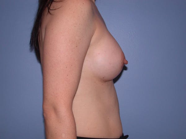 Breast Augmentation Gallery Before & After Gallery - Patient 4757581 - Image 4