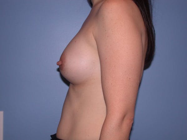 Breast Augmentation Gallery Before & After Gallery - Patient 4757581 - Image 6