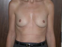 Breast Augmentation Before & After Gallery - Patient 4757589 - Image 1