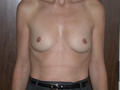 Breast Augmentation Gallery Before & After Gallery - Patient 4757589 - Image 1