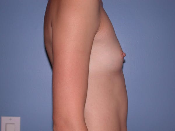 Breast Augmentation Gallery Before & After Gallery - Patient 4757599 - Image 3