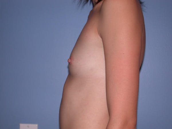 Breast Augmentation Gallery Before & After Gallery - Patient 4757599 - Image 5