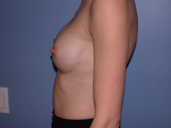 Breast Augmentation Gallery Before & After Gallery - Patient 4757599 - Image 6