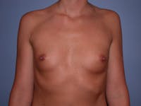 Breast Augmentation Gallery Before & After Gallery - Patient 4757603 - Image 1