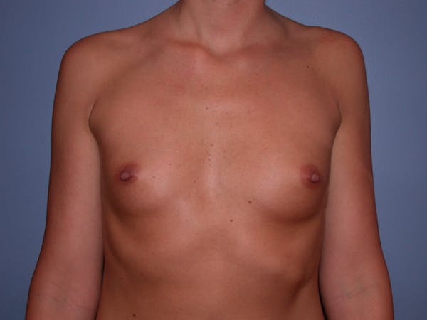 Breast Augmentation Before & After Gallery - Patient 4757603 - Image 1