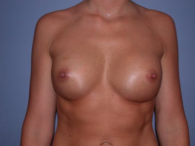 Breast Augmentation Gallery Before & After Gallery - Patient 4757603 - Image 2