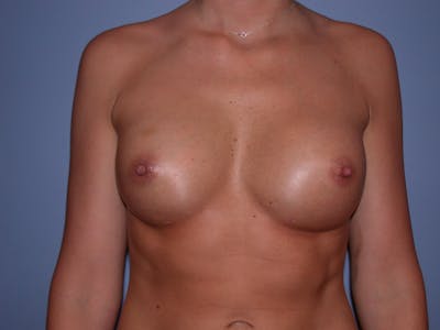 Breast Augmentation Before & After Gallery - Patient 4757603 - Image 2