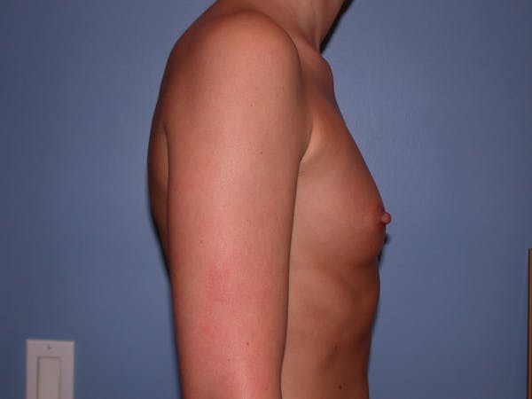 Breast Augmentation Gallery Before & After Gallery - Patient 4757603 - Image 3