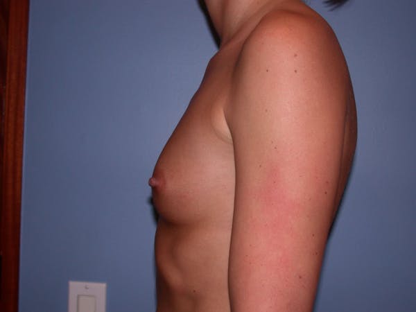 Breast Augmentation Gallery Before & After Gallery - Patient 4757603 - Image 5