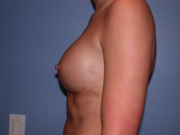 Breast Augmentation Before & After Gallery - Patient 4757603 - Image 6