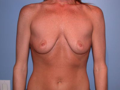 Breast Augmentation Gallery Before & After Gallery - Patient 4757607 - Image 1