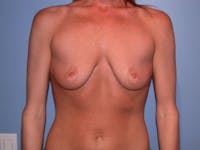 Breast Augmentation Before & After Gallery - Patient 4757607 - Image 1