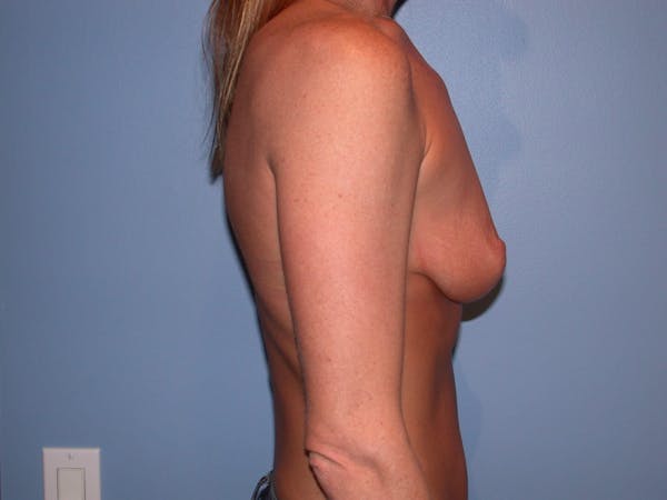 Breast Augmentation Gallery Before & After Gallery - Patient 4757607 - Image 3