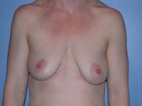 Breast Augmentation Gallery - Patient 4757611 - Image 1