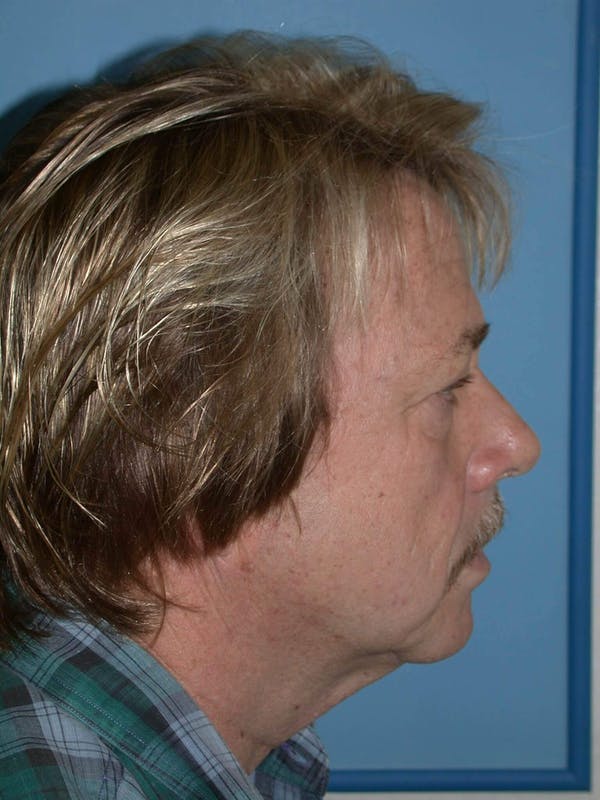Male Facial Procedures Gallery Before & After Gallery - Patient 6096738 - Image 3