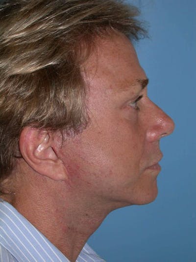 Male Facial Procedures Gallery Before & After Gallery - Patient 6096738 - Image 4