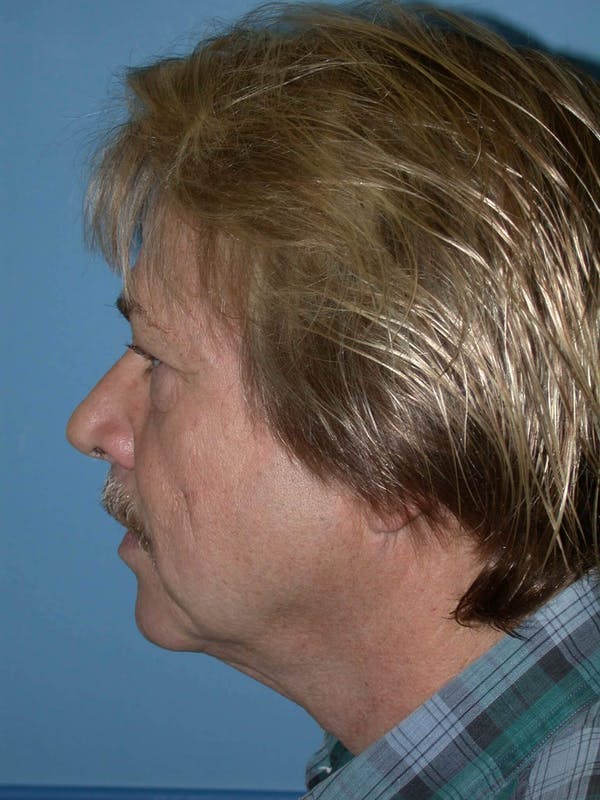 Male Facial Procedures Gallery Before & After Gallery - Patient 6096738 - Image 5