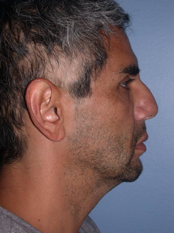 Male Facial Procedures Gallery Before & After Gallery - Patient 6096739 - Image 5