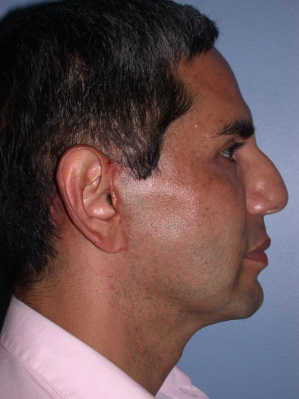 Male Facial Procedures Gallery Before & After Gallery - Patient 6096739 - Image 6