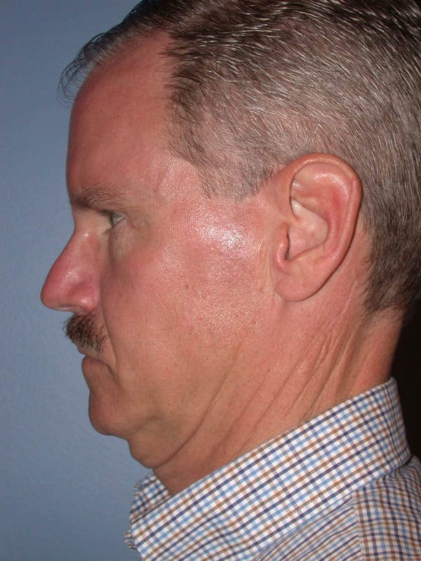 Male Facial Procedures Gallery Before & After Gallery - Patient 6096740 - Image 3