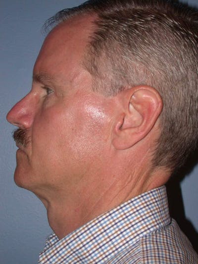 Male Facial Procedures Gallery Before & After Gallery - Patient 6096740 - Image 4