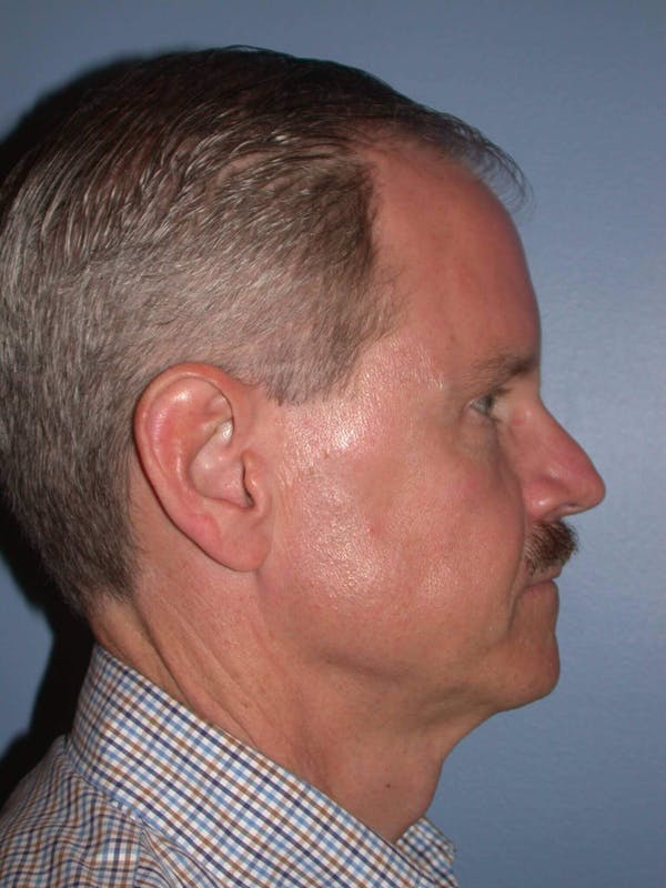 Male Facial Procedures Gallery Before & After Gallery - Patient 6096740 - Image 5
