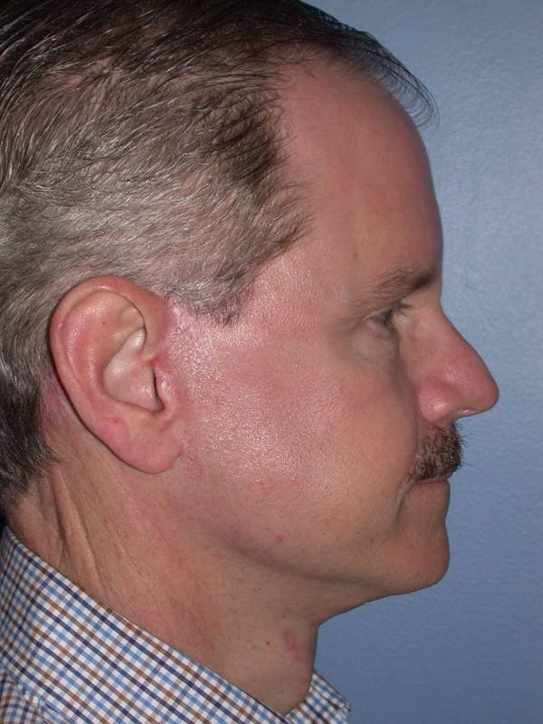 Male Facial Procedures Gallery Before & After Gallery - Patient 6096740 - Image 6