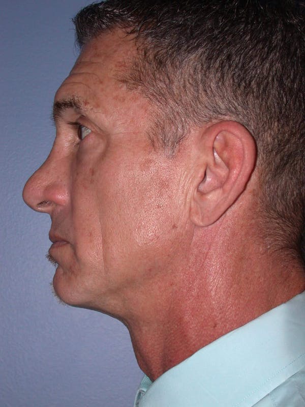 Male Facial Procedures Gallery Before & After Gallery - Patient 6096741 - Image 3