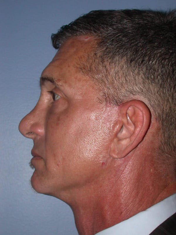 Male Facial Procedures Before & After Gallery - Patient 6096741 - Image 4