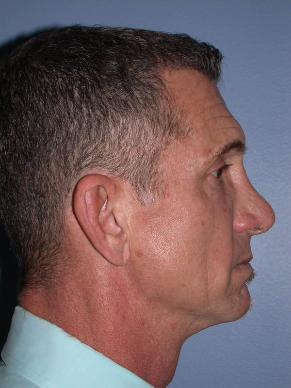 Male Facial Procedures Gallery Before & After Gallery - Patient 6096741 - Image 5