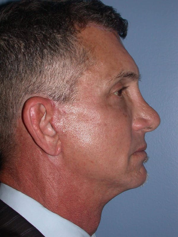 Male Facial Procedures Gallery Before & After Gallery - Patient 6096741 - Image 6