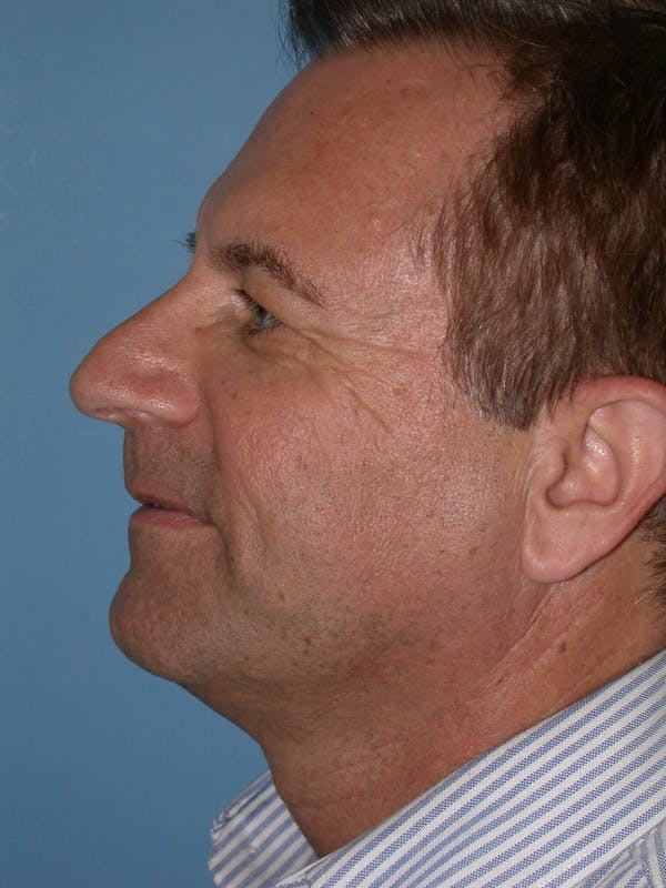 Male Facial Procedures Gallery Before & After Gallery - Patient 6096742 - Image 3