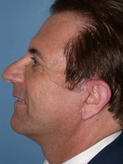 Male Facial Procedures Gallery - Patient 6096742 - Image 4