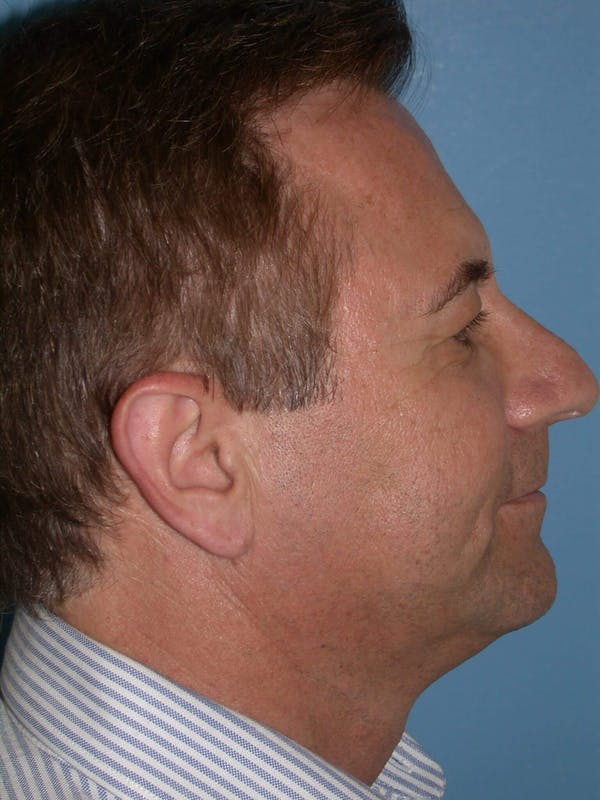 Male Facial Procedures Gallery Before & After Gallery - Patient 6096742 - Image 5