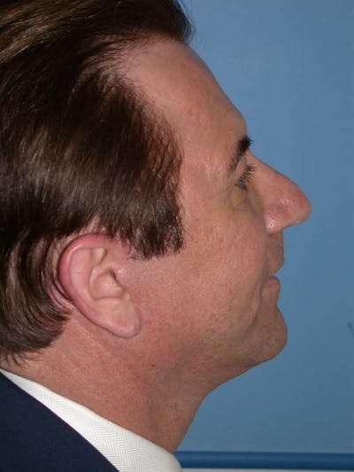 Male Facial Procedures Gallery - Patient 6096742 - Image 6