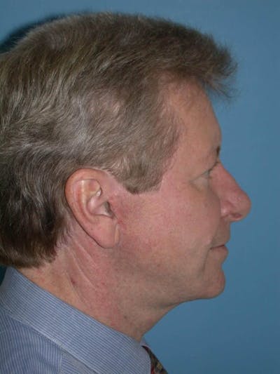 Male Facial Procedures Gallery Before & After Gallery - Patient 6096743 - Image 4